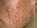 Research questions about acne image
